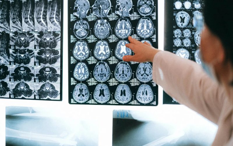 Impulsan una nueva terapia para las personas con daño cerebral